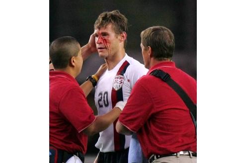 ...Brian McBride trägt eine blutende Platzwunde davon.