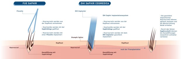 FUE und DHI Saphir im Vergleich.